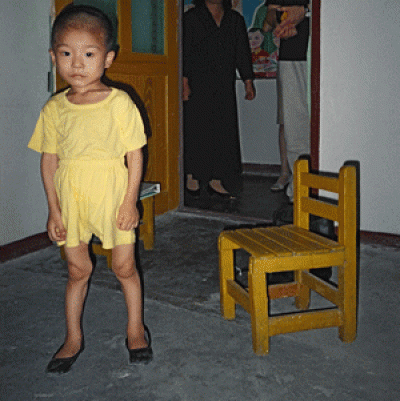 Trẻ suy dinh dưỡng: Những hình ảnh thương tâm | Giáo dục Việt Nam