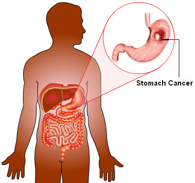 Ung thư dạ dày thường phát triển trong các mô lót dạ dày. Theo Hiệp hội Ung thư Quốc gia Mỹ, có 21.130 trường hợp ung thư dạ dày ở Mỹ trong năm 2009.