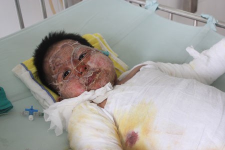 Khuôn mặt của bé Thảo bị cháy xạm đen do bỏng dầu đến 85% cơ thể ảnh 1