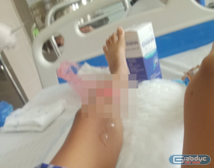 Thương tích của bé Hằng ở chân là khá nặng. (Ảnh: NVCC) Thương tích của bé Hằng ở chân là khá nặng. (Ảnh: NVCC)