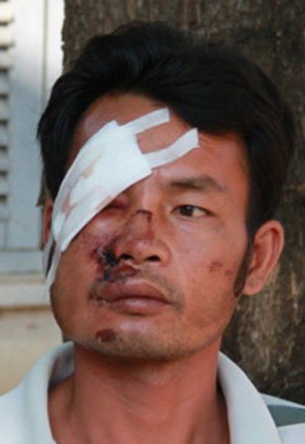 Một nạn nhân bị thương ở vùng mặt