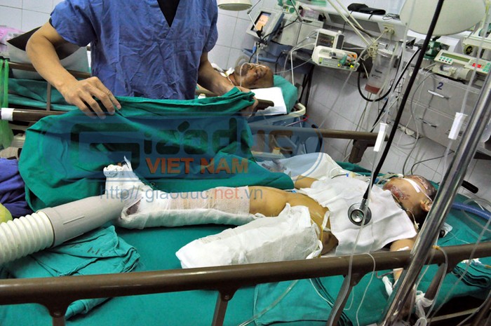 Cháu Vân nhập viện Việt Đức trong tình trạng bị bỏng nặng ở phần mặt, ngực và tay... (Ảnh chụp trong BV Việt Đức)
