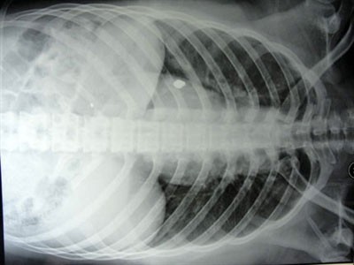 Ảnh chụp X-Quang hình viên đạn găm trong phổi của Tuyết.