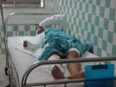 Chị D. đang điều trị tại Khoa Bỏng – tạo hình Bệnh viện Đà Nẵng (ảnh chụp sáng 30-5)