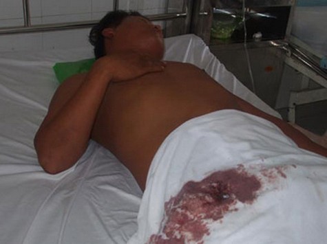 Anh Tuấn sau phẫu thuật gắp đầu đạn tại Bệnh viện Cà Mau. Ảnh: T.L.