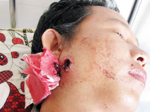 Vết thương của anh Quang do bị trúng đạn từ khẩu súng của Dũng. Ảnh do gia đình cung cấp.