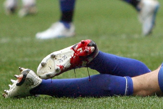 Jmaes Vaughan - cầu thủ trẻ nhất ghi bàn trong lịch sử Premier League khi mới 16 tuổi 271 ngày đã gặp phải rất nhiều chấn thương, và một trong những chấn thương nặng nhất khi khoác áo CLB Everton là ở mắt cá chân.