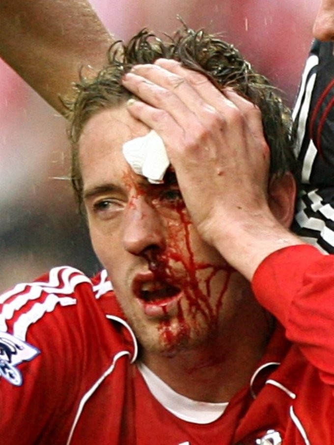Khuân mặt đầy máu của tiền đạo Peter Crouch khi còn khoác áo Liverpool.