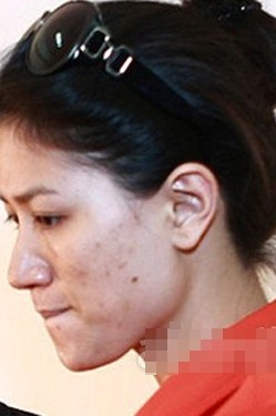 Da mặt của người mẫu Trang Trần thì dày đặc những vết thâm, hậu quả của mụn mang lại