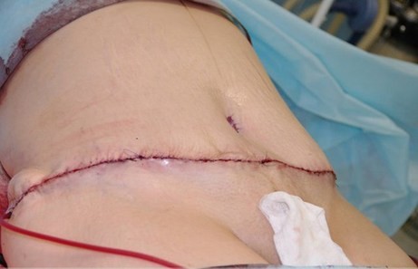 Hình ảnh phần bụng sau khi được hút mỡ và căng da. Thời gian để bệnh nhân bình phục vào khoảng 10 ngày. Tuy nhiên, phẫu thuật hút mỡ bụng căng da bụng nếu không cẩn thận sẽ dễ bị nhiễm trùng, thậm chí ảnh hưởng đến tính mạng.