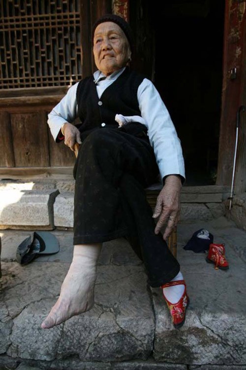Bàn chân bị biến dạng khi cụ bỏ giày