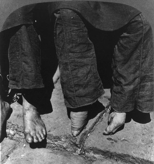 Bàn chân phụ nữ bình thường và bàn chân bị bó (Ảnh chụp tại Quảng Đông, Trung Quốc).