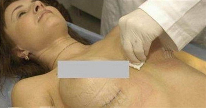 Hình ảnh trong màn phẫu thuật nâng ngực