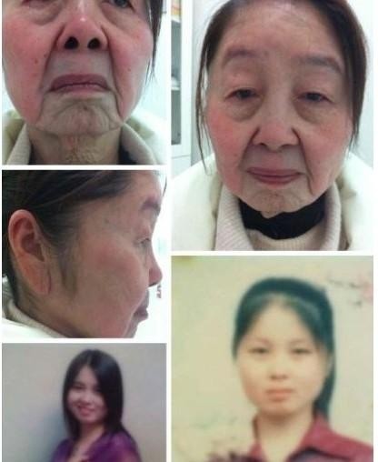 Hình ảnh phụ nữ trước và sau khi phẫu thuật thẫm mỹ.