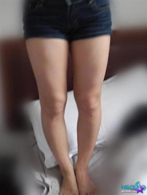 Đôi chân của cô gái trước khi tiến hành phẫu thuật