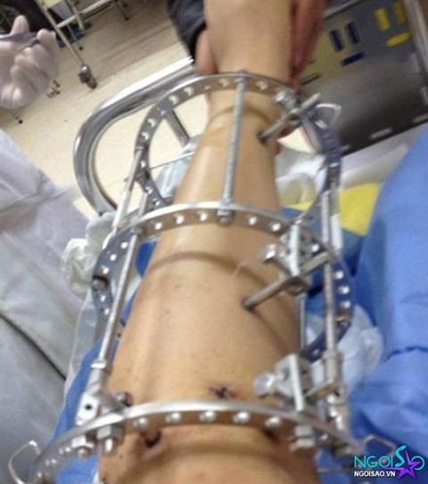 Để tiến hành phẫu thuật kéo dài chân, bác sỹ sẽ dùng một dụng cụ được đặt xung quanh chân, một số vít sẽ được xuyên qua xương nhằm cố định các đoạn xương cần cắt rời để kéo dài.