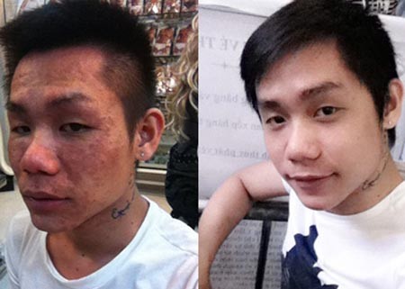 Cậu hot boy A.S trước và sau khi tiêm trắng với khuôn mặt biến dạng hoàn toàn