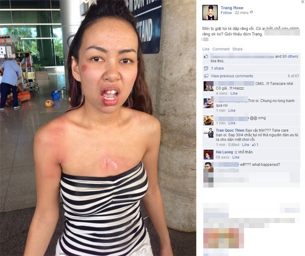 Ca sĩ Thảo Trang bị cướp ngã bầm mặt, hỏng răng