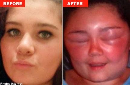 Khuôn mặt của Lauren lúc đầu và sau khi bị dị ứng