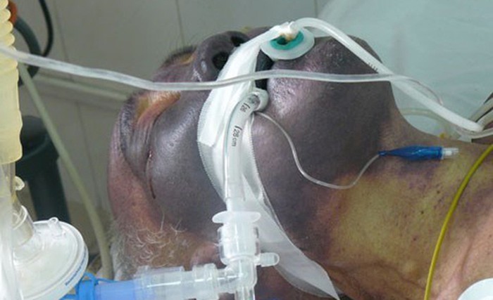 Một trường hợp người dân ăn tiết canh lợn bị mắc liên cầu lợn điều trị tại Bệnh viện Bệnh nhiệt đới Trung ương.