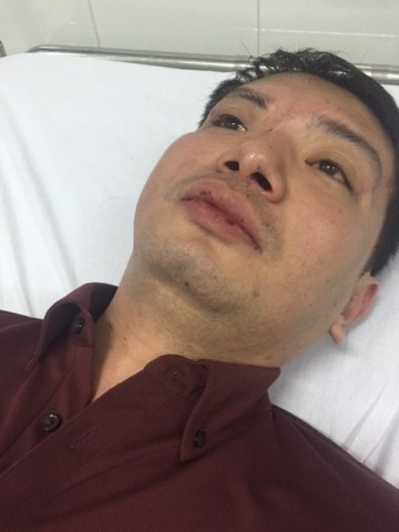 Anh Nguyễn Như Toàn với những vết thương bầm dập trên môi của mình.
