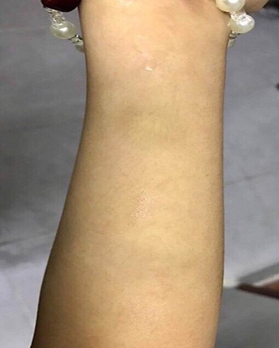 Hình ảnh chứng minh bé N.A bị cô H. đánh là có thương tích, là vết bầm tím trên tay (Ảnh: B.A)