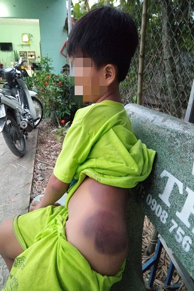 Em Khang bị bầm tím ở lưng, mông sau khi bị cô Vui đánh (ảnh: vtc.vn)