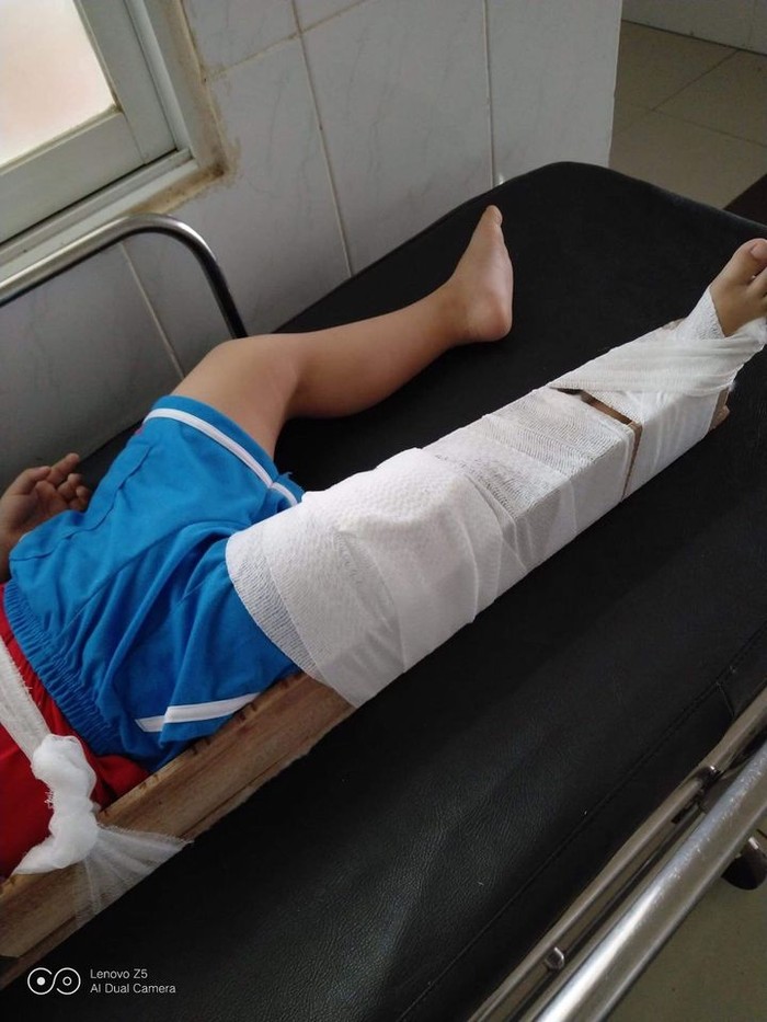 Con trai của chị C. bị gãy chân sau một tai nạn trong giờ học ở trường (ảnh: CTV)