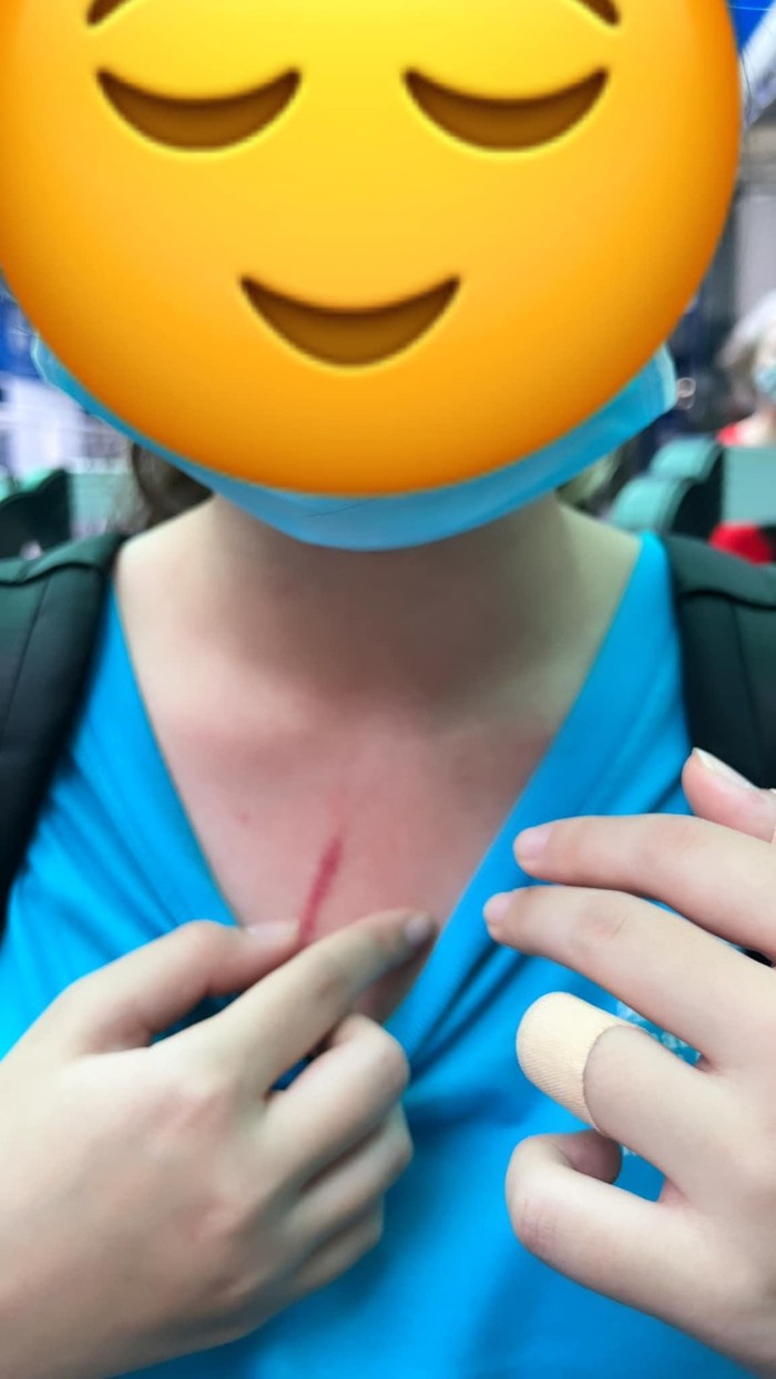 Vết xước trên cổ của một nữ sinh được cho là đã bị bạn đánh (ảnh: FB T.H.T.)