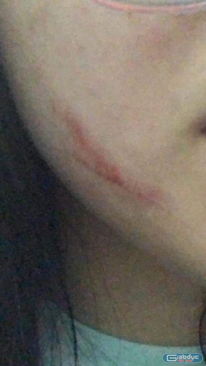 Vết thương còn hiện rõ trên mặt em T. sau khi bị bạn tát (ảnh: CTV)