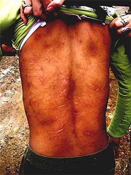 Hàng trăm vết sẹo trên lưng cô bé Nguyễn Thị Bình (Ảnh: Tiền Phong).