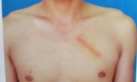 Sau hơn 2 tuần nhưng vết thương trên ngực anh Anh vẫn còn in rõ vết bầm tím.