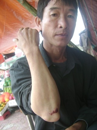 Ông Kiều Thái Hồng và vết thương do vụ va chạm giao thông với ông Dương gây nên vẫn còn bức xúc trước hành vi ứng xử của vị PGĐ sở Tài nguyên Môi trường Hà Tĩnh