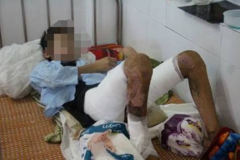 Cháu T. hiện đang điều trị tại Bệnh viện Đa khoa tỉnh Hà Tĩnh với vết bỏng toàn thân, nhất là vùng đùi và chân