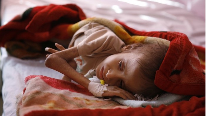 Trẻ em Yemen đang đau khổ vì tình trạng thiếu lương thực và thuốc chữa bệnh (Ảnh: AP)