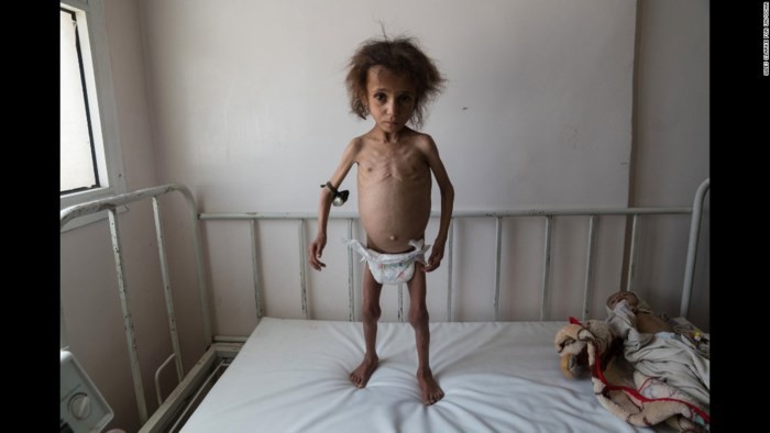 Một cậu bé Yemen 6 tuổi bị suy dinh dưỡng nghiêm trọng (Ảnh: AP)