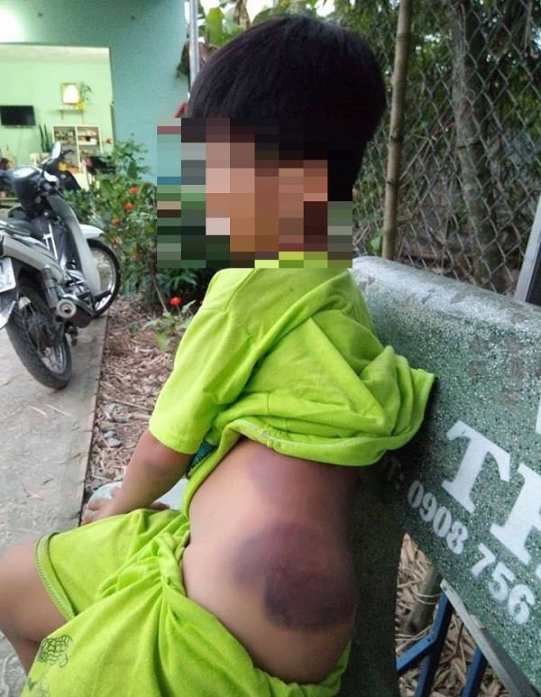 Hình ảnh học sinh ở trường Tiểu học Bình Hữu bị cô giáo đánh tím bầm người được lan truyền trên mạng xã hội. Ảnh: Baodansinh.vn