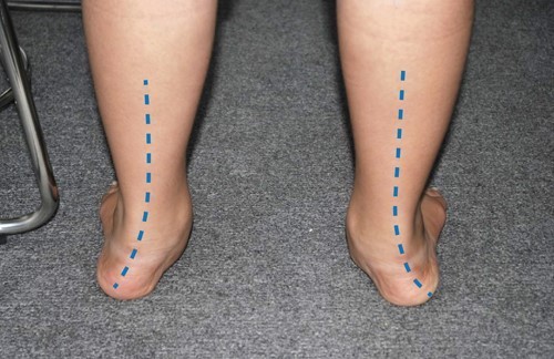 Bàn chân bẹt có xu hướng áp sát vào bên trong hoặc bên ngoài