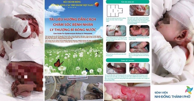 Tài liệu hướng dẫn chăm sóc bệnh nhân ly thượng bì bóng nước của Bệnh viện Nhi đồng Thành phố Hồ Chí Minh