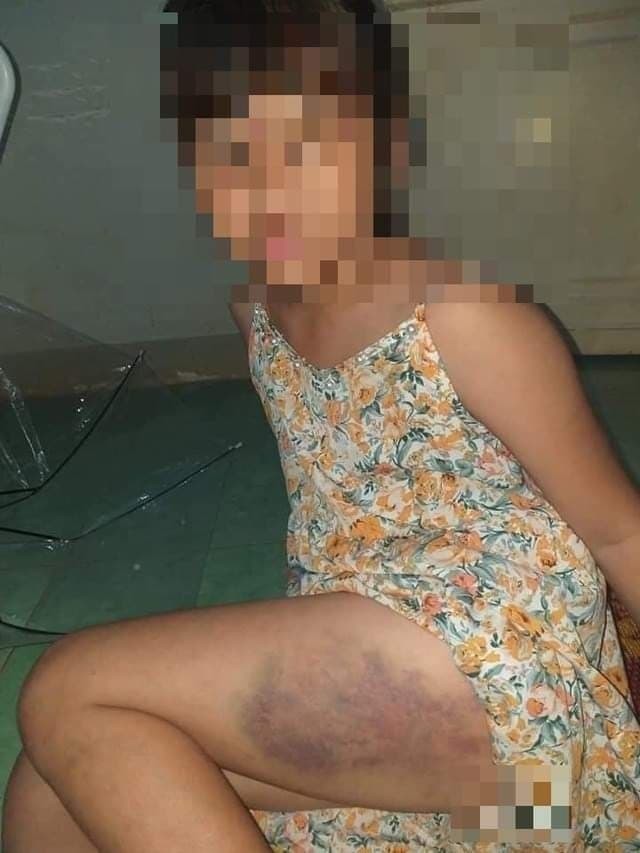 Bé gái bị đánh thâm đùi vì làm bài sơ sài (Ảnh: Nguoiduatin.vn)
