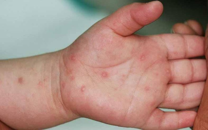 Bệnh tay chân miệng do các loại vi rút thuộc họ vi rút đường tiêu hóa (gọi chung là Enterovirus) gây ra. (Ảnh: Nhandan.com.vn)