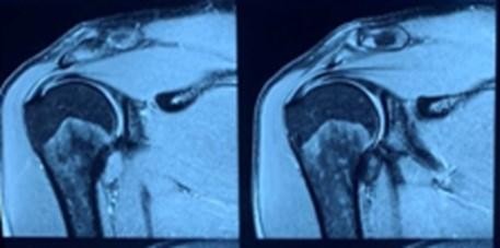 Phim MRI chưa có tiêm thuốc cản quang hình ảnh tổn thương không thật điển hình