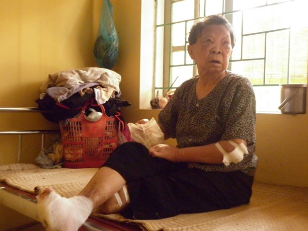 Cụ Vũ Thị Bớt (89 tuổi, xã Dũng Tiến, huyện Thường Tín, TP Hà Nội) với đôi chân đang dần vị ăn mòn vì căn bênh phong quái ác.