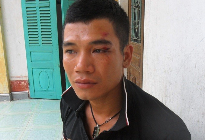 Anh Nguyễn Văn Tảo bị vết thương sâu ở mắt do vụ tai nạn gây nên