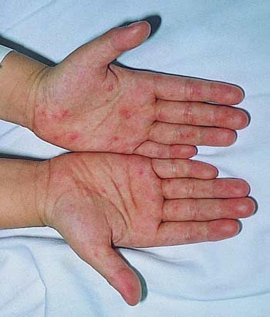 Bệnh Tay – Chân – Miệng do một nhóm virus thuộc nhóm Enterovirus gây nên. Tác nhân thường gặp nhất là Coxsackievirus A16, đôi khi do Enterovirus 71 và các virus ruột khác. Nhóm virus ruột bao gồm các phân nhóm virus Poliovirus, coxsackievirus, Echovirus và một số enterovirus khác .