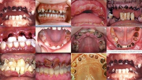 Có rất nhiều nguyên nhân dẫn đến sâu răng ở trẻ. Trong đó, nguyên nhân chính dẫn đến sâu răng (sún răng) và viêm lợi là vệ sinh răng miệng không sạch và không thường xuyên.