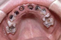 Đặc biệt, khi trẻ bị sâu răng sẽ ảnh hưởng rất lớn đối với hệ thần kinh của trẻ.