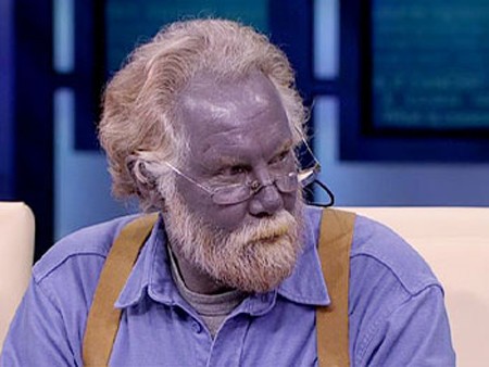 Mới đây, ở bang California (Mỹ) cũng đã xuất hiện người đàn ông 57 tuổi mắc chứng bệnh da xanh này. Theo giới y học nguyên nhân gây ra bệnh này là do người bệnh đã ăn một lượng bạc vào trong cơ thể (tuy nhiên đây chỉ là những phán đoán ban đầu)