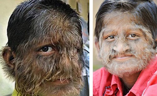 Hội chứng ma sói: Những người mắc bệnh này có khuôn mặt và cơ thể bị bao phủ bởi lông. Mặc dù vậy, người mắc bệnh này vẫn sống khỏe mạnh và không bị ngứa ngáy gì.