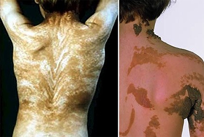Bệnh Blaschko với những sọc vằn trên cơ thể: Căn bệnh này được phát hiện lần đầu vào năm 1901 bởi bác sỹ chuyên khoa da liễu Alfred Blaschko.